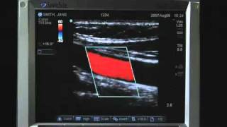 Sonosite MTurbo Product Training Part 2 Screen Layout [upl. by Hnahym605]