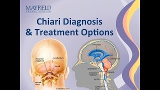 Chiari Malformation Diagnosis amp Treatment Options [upl. by Arimay934]