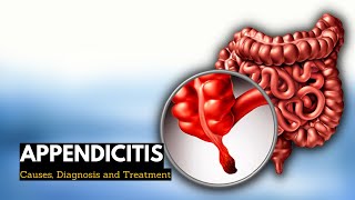 How do I know if I have appendicitis [upl. by Stirling912]