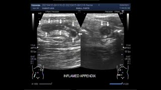 Localization of the inflamed Appendix [upl. by Brian]