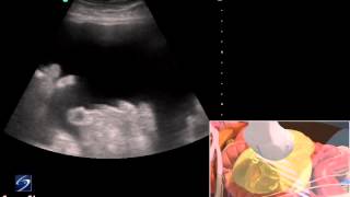 3D How To Ultrasound Guided Paracentesis Procedure  SonoSite Ultrasound [upl. by Elbas115]