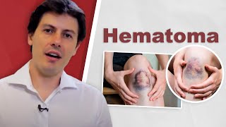 Hematoma Dr Fernando Amato [upl. by Budde]